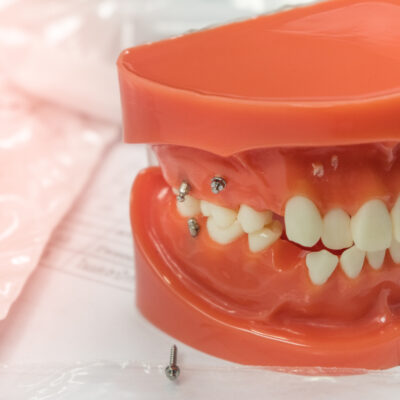 歯列矯正の革命「アンカースクリュー」って何？
